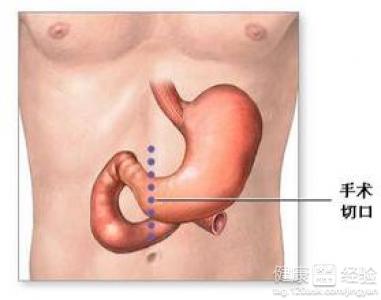 淺表性胃炎有哪些症狀