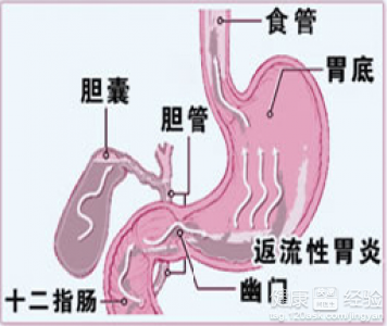 慢性淺表性胃炎伴膽汁反流症狀