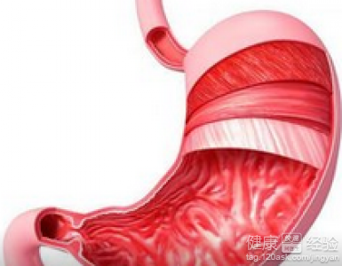 萎縮性胃炎的危害有哪些