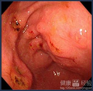 如何辯證治療慢性淺表性糜爛性胃炎