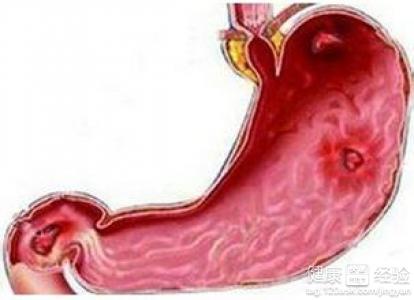 慢性糜爛性胃炎有哪些症狀呢