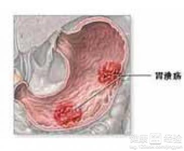 淺表性糜爛性胃炎能治好不呢