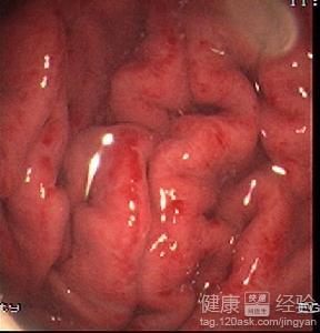 糜爛性胃炎具有什麼的症狀呢