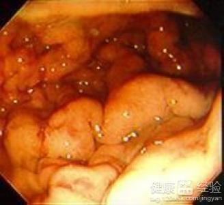 糜爛性胃炎的症狀有哪些？
