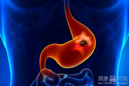 胃潰瘍的早期症狀及治療
