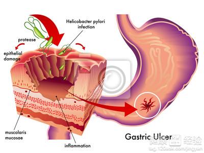 胃潰瘍臨床有哪些症狀