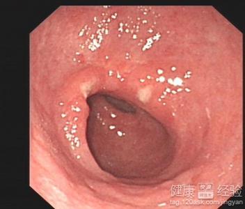 調養胃潰瘍應注意什麼