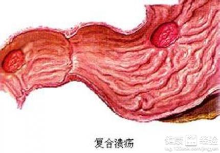 胃潰瘍形成的原因