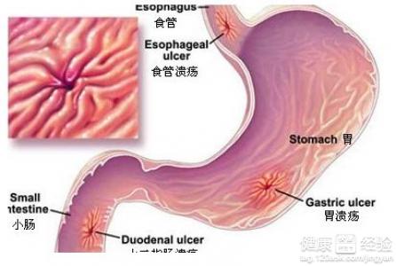 胃潰瘍的飲食應注意哪些