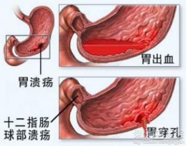 什麼是慢性胃潰瘍