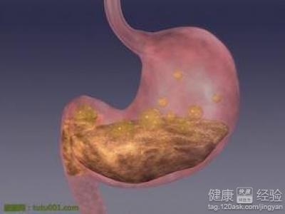 胃潰瘍的症狀是什麼