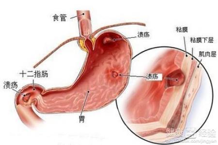 胃潰瘍是什麼原因