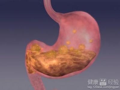 胃酸胃潰瘍的治療和預防方法