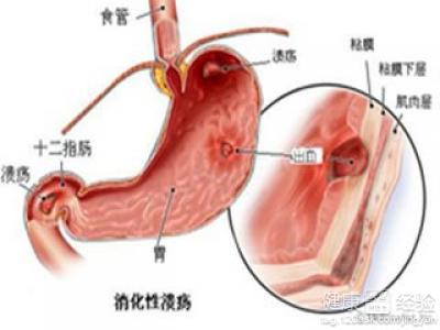 胃潰瘍由什麼症狀
