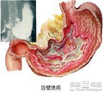 胃潰瘍確診的方法