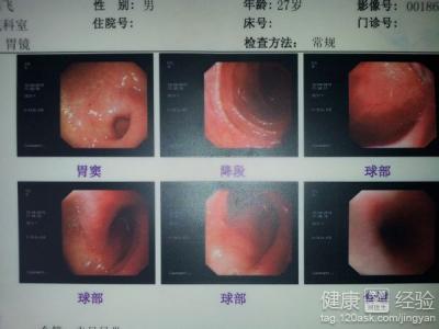 十二脂腸胃潰瘍的症狀及治療