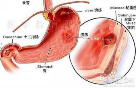 胃潰瘍的初期症狀