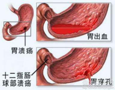 胃潰瘍和十二指腸潰瘍的症狀