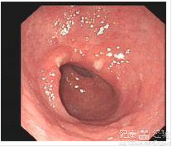 胃潰瘍吃什麼主食物好