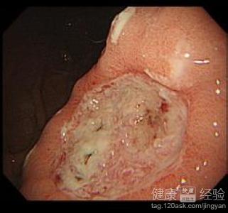 胃潰瘍與十二指腸潰瘍有何區別