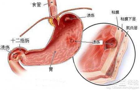 胃潰瘍有哪些好的護理方法？