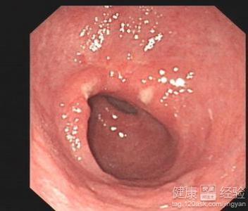 胃潰瘍的病人有什麼注意事項？