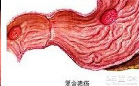 慢性的胃潰瘍要如何治療呢？