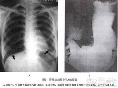 胃潰瘍的幾種治療方法