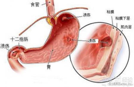 胃潰瘍怎麼治？