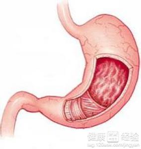 慢性胃窦炎用什麼藥