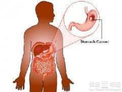 慢性胃窦炎的偏方有哪些