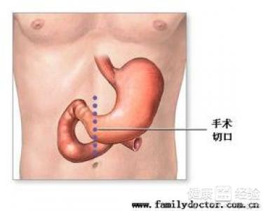 慢性糜爛性胃窦炎吃什麼藥