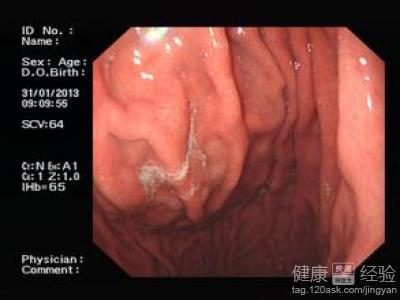 萎縮性胃窦炎的飲食有哪些