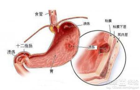 慢性胃窦炎如何飲食