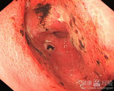 慢性隆起糜爛性胃窦炎是怎麼檢查出來的