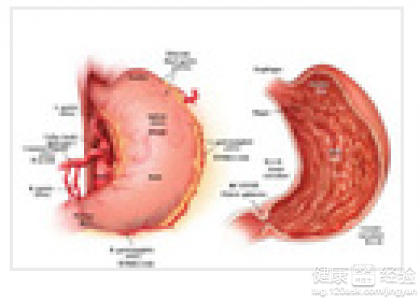 慢性隆起糜爛性胃窦炎的症狀有哪些