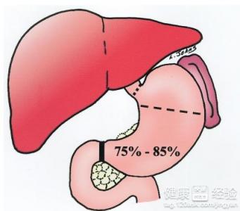 萎縮性胃窦炎手術中該注意些什麼