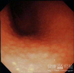 紅斑滲出性胃窦炎手術中該注意些什麼