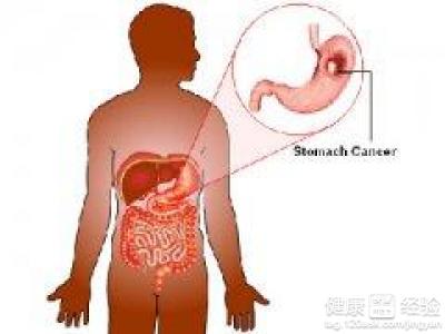 慢性胃窦炎經常燒心該怎麼緩解
