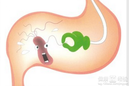 伴隨胃窦炎咽部有異物感是怎麼回事