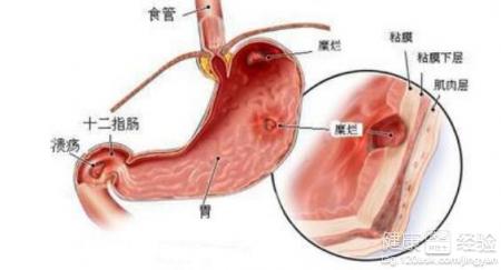胃潰瘍胃窦炎如何治療