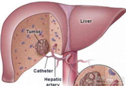 肝血管瘤患者需要做哪些檢查