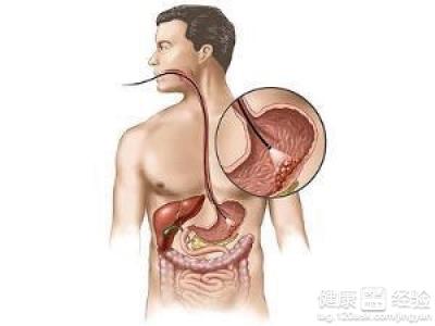 慢性萎縮性胃炎怎樣治療和保養