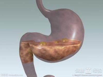 胃潰瘍與其它病症的不同的鑒別