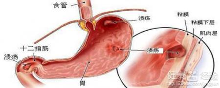 胃潰瘍患者會出現周期性節律性上腹痛