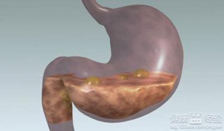 常見的胃潰瘍的症狀表現都有什麼
