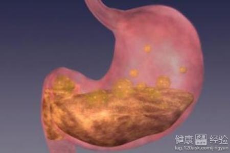 易誘發胃潰瘍發生的主要因素是什麼
