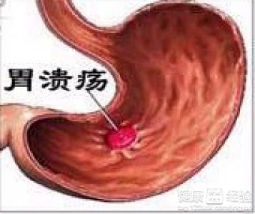 胃潰瘍的危害有哪些?