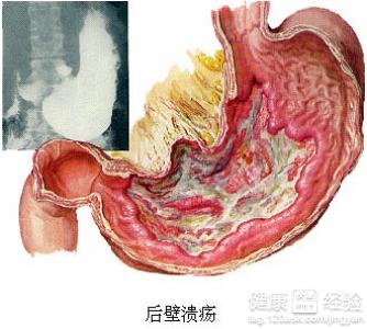 胃潰瘍疼痛的特點有哪些