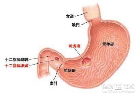 胃潰瘍有哪些典型表現